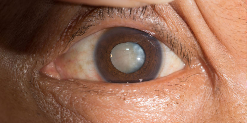 Ojo con catarata para valoración quirúrgica